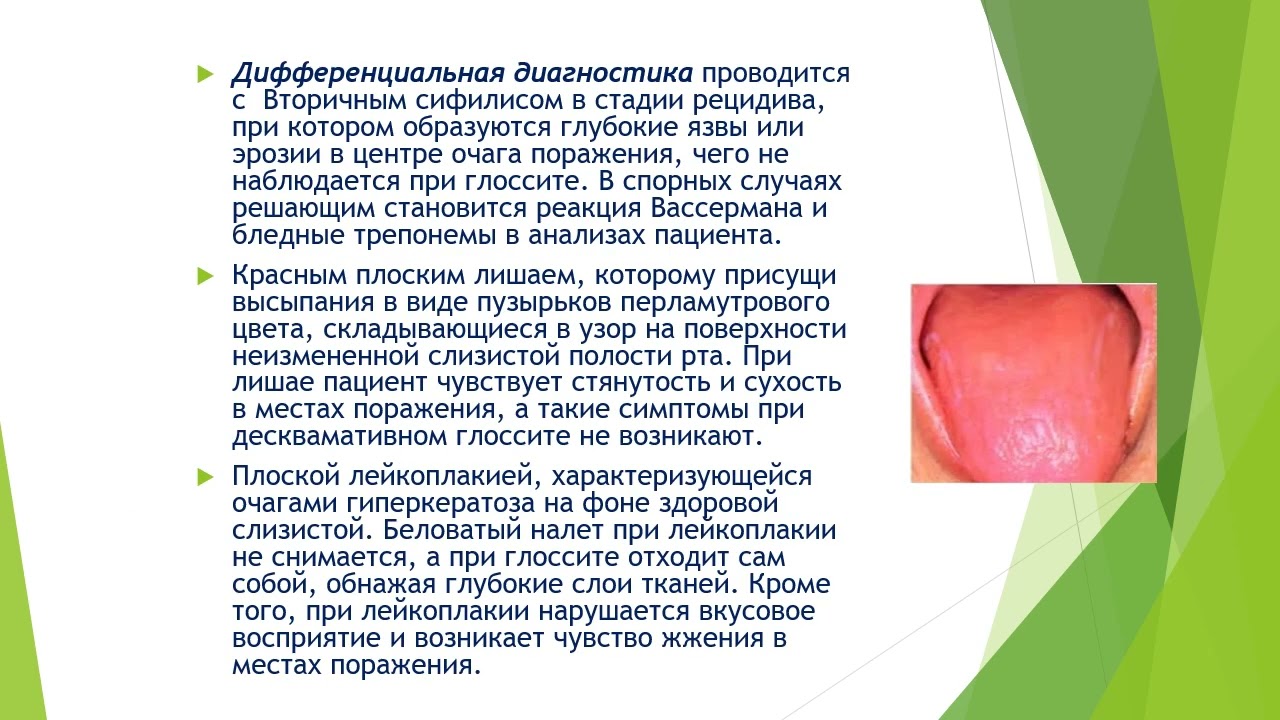 Глосситы. Классификация, клиника, этиология, патогенез, лечение