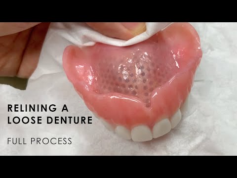 Relining a Loose Denture - Full Process