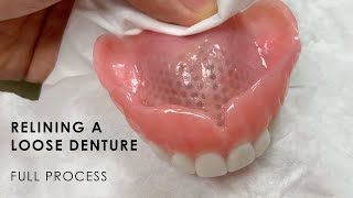 Relining a Loose Denture - Full Process