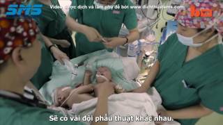 Cặp song sinh dính liền được tách ra bằng công nghệ 3D (Dịch & phụ đề bởi Dịch Thuật SMS)