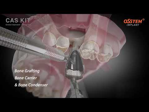 CAS KIT (Crestal Approach Sinus Kit)