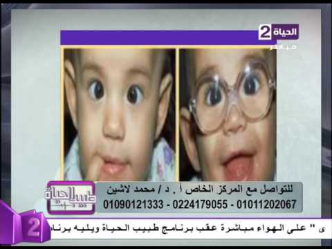 طبيب الحياة - أ.د \ محمد لاشين ... أهم أسباب الحول ومشاكل الحول عند الأطفال