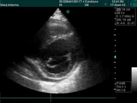 Cardiopathie ischémique à l'examen d'échocardiographie