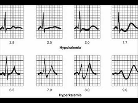 A hipertóniát meghatározhatja-e ekg. Tényeken Alapuló Orvostudomány Módszertani Ajánlások