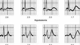 Most Important ECG Findings in Major Diseases