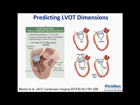 Challenges of TMVR for Severe MAC - Mayra Guerrero, MD