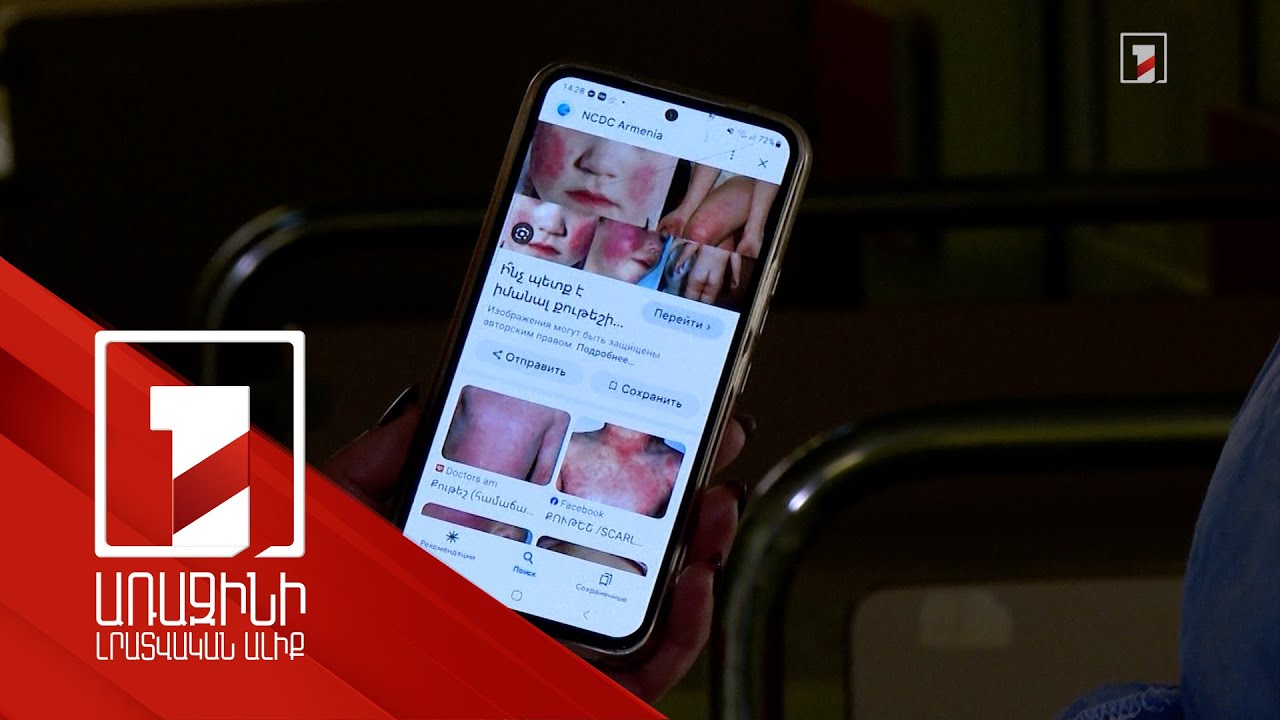 Միայն հունվարին Հայաստանում գրանցվել է սուր վարակիչ համարվող քութեշ հիվանդության 162 դեպք