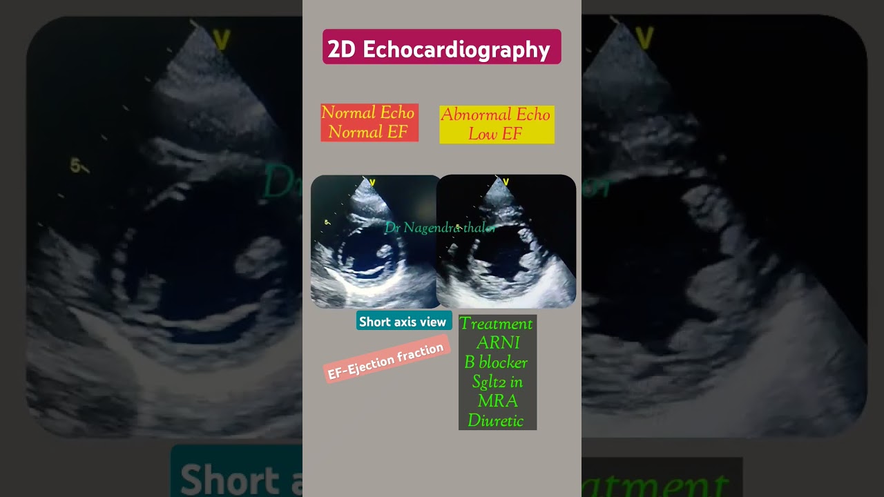 Normal and abnormal Echo l Ejection fraction l Heart pumping Power #echo #shorts