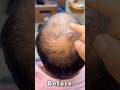 Low Density Hair Patch Anas Sheikh Hair Solution Buy Online Hair Patch Wigs Hairloss Patch