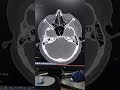 CT SCAN OF PNS Viral Shortfeeds Medical