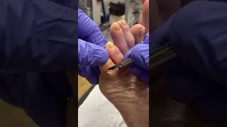 Corn Removal by Podiatrist: Expert Solutions for Little Toe Corns