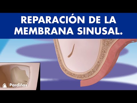Reparación de la membrana sinusal ©