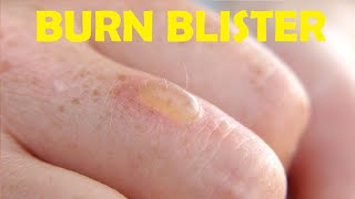 how to get rid of a burn blister without popping it