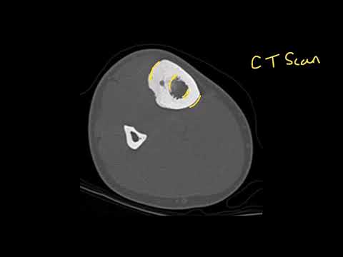 Radiological features of osteoid osteoma