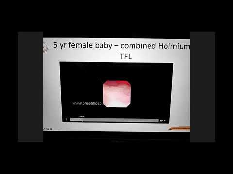 RIRS in Pediatric population   Dr  Chandramohan Vaddi