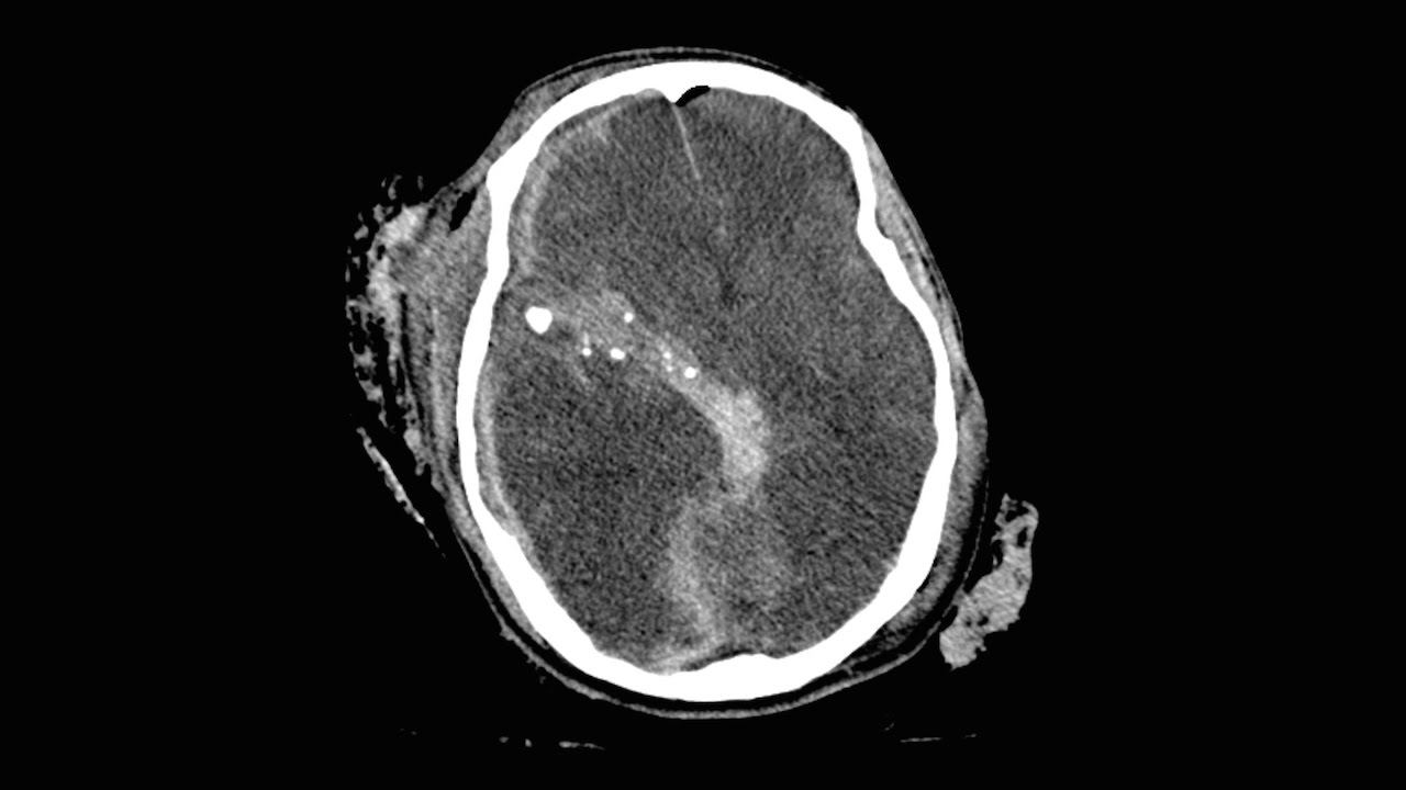 Predicting outcomes after trauma to the brain