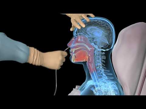 NG intubation - Inserting a nasogastric tube - 3D animation