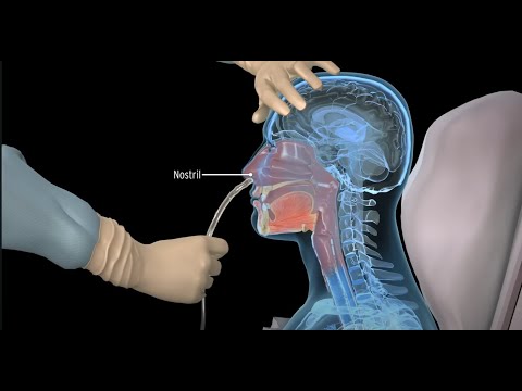 NG intubation - Inserting a nasogastric tube - 3D animation