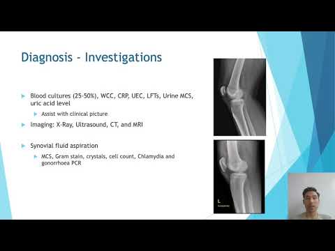 Septic Arthritis by Dr Tim Wright