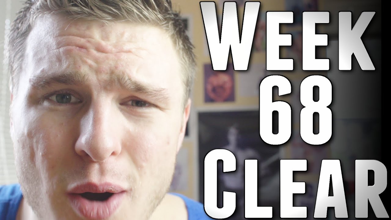 Watch video Week 68 of Accutane | Post-Extraction Results & 90% Clear! Now Week 68 of Accutane | Post-Extraction Results & 90% Clear!