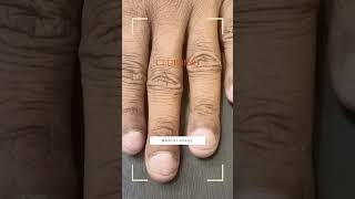 CLUBBING OF FINGERS - CYANOSIS - CYANOTIC HEART DISEASE #shorts #dmheartcareclinic