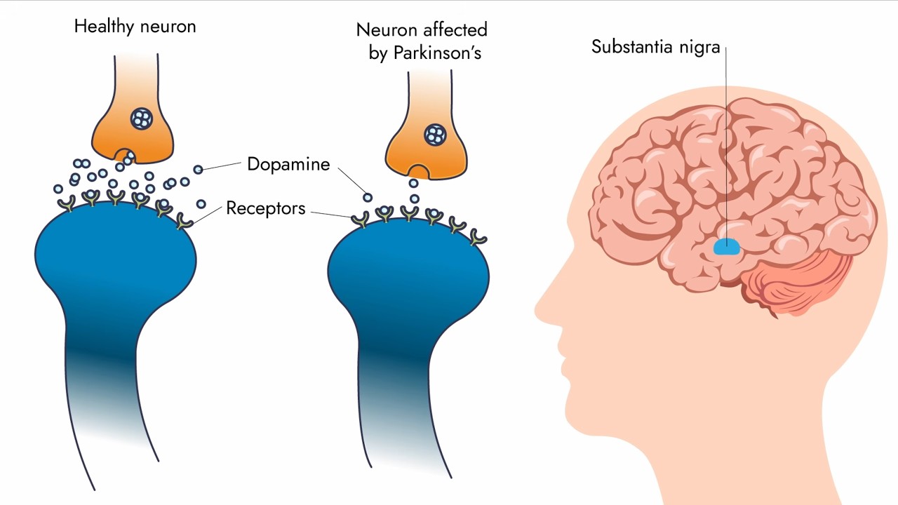 Parkinson’s Disease: Dopamine Receptor Agonists and Monoamine Oxidase B Inhibitors