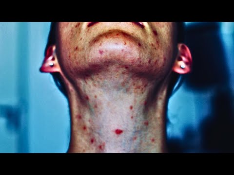 Du bist Ende zwanzig und hast immer noch Pickel wie in der Pubertät? | Food For Your Skin