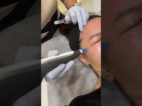  Patient Honest Review of Dermapen 4 Microneedling 