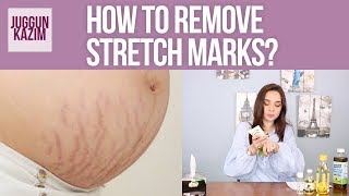 Remedies for Stretch Marks  Post Pregnancy Stretch