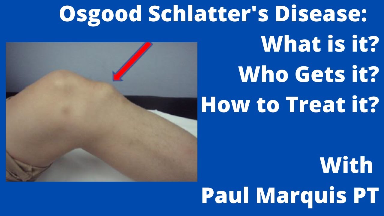 How can OsgoodSchlatter be treated? Tipseri