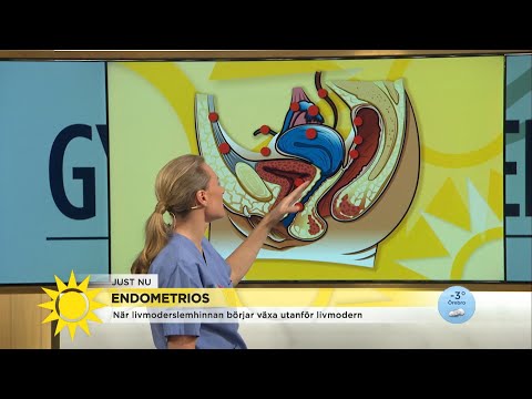 Gynekologen om endometrios: ”Menssmärtor jämt, kroniskt” - Nyhetsmorgon (TV4)