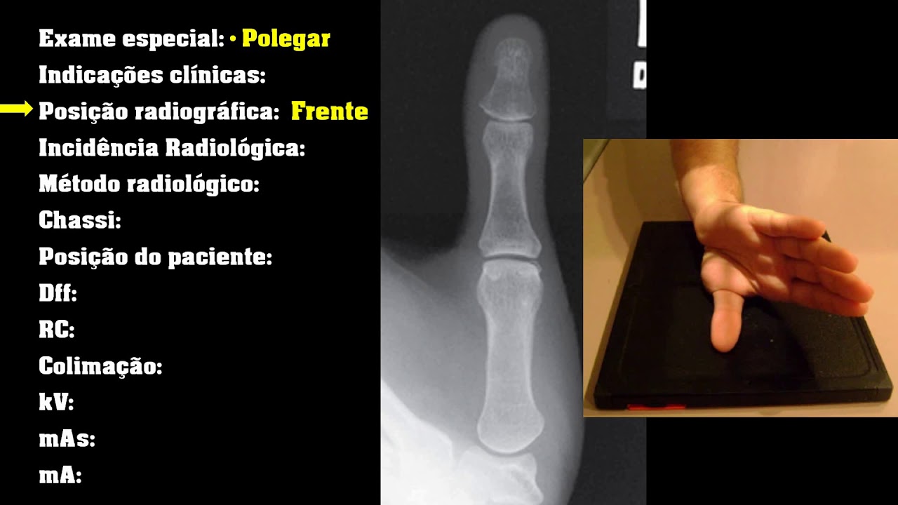 Radiologia: Exames especiais - Polegar Robert