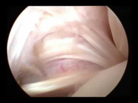 Chondrose Heilung für Halswirbelsäule Tendinose Bereich des Trochanter major des Hüftgelenks