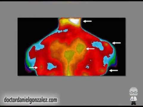 Cómo se diagnostica la fibromialgia