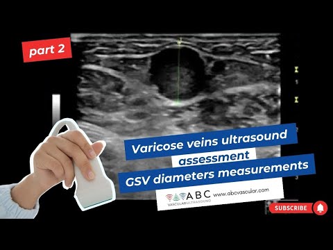 Part 2: Varicose veins ultrasound assessment: great saphenous vein diameters measurements