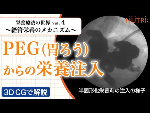 栄養学科 栄養療法の世界Vol.4　経管栄養のメカニズム〈3D CG解説〉－PEG（胃ろう）からの栄養注入－