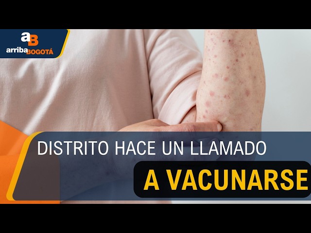 Confirman tres casos de sarampión en el país; dos se detectaron en Bogotá