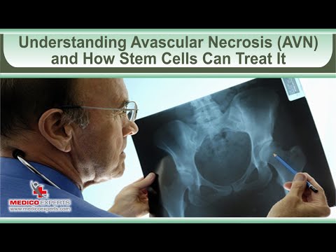 Understanding Avascular Necrosis AVN and How Stem Cells Can Treat It