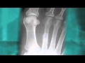 Brooklyn Podiatrist Dr. Michael Perlstein - Why Does My Heel Hurt?