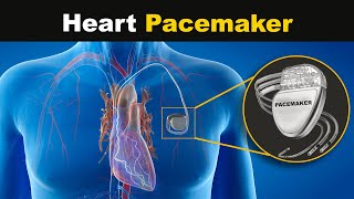 How Heart Pacemaker works? (Urdu/Hindi)