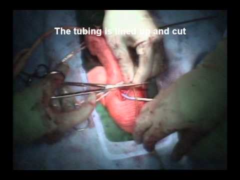 Penile Implant Surgery 