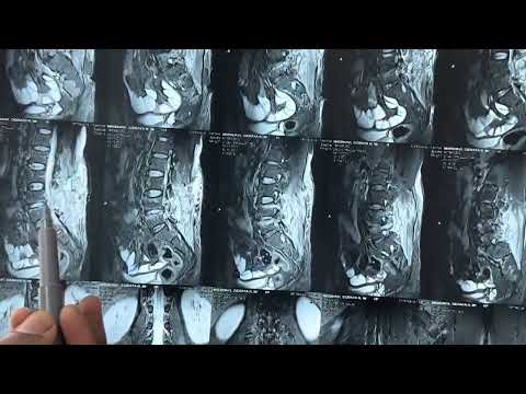 Post operative spine Infection:What to do?