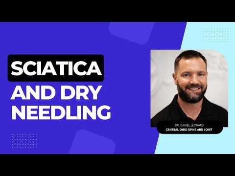 坐骨神經痛與乾針治療？讓你擺脫疼痛的終極指南！ (Sciatica and Dry Needling)