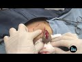 SOCIAL DISTANCING Means SOCIAL CYST ANCING