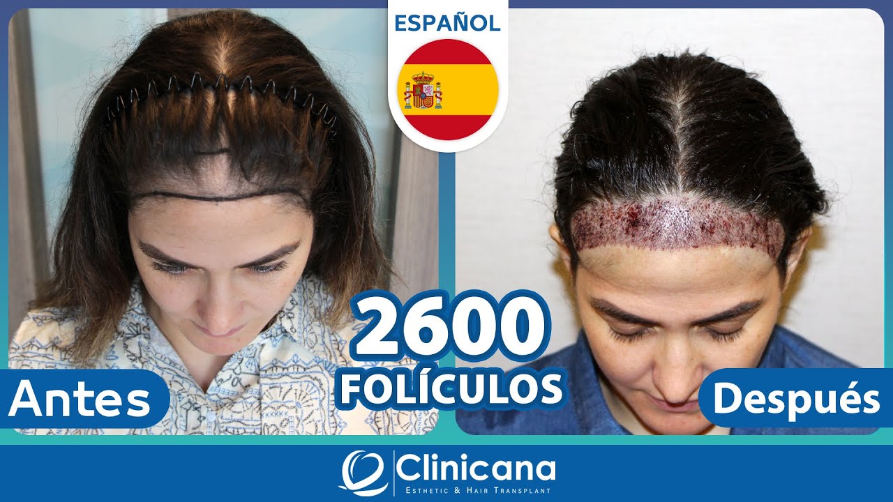Watch Trasplante Capilar para Mujeres Turquia | ¿Cómo es el injerto de pelo en mujeres Now Trasplante Capilar para Mujeres Turquia | ¿Cómo es el injerto de pelo en mujeres