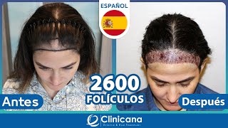 Trasplante Capilar para Mujeres Turquia | ¿Cómo es el injerto de pelo en mujeres