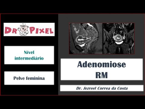 Adenomiose pela RM