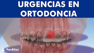 Urgencias en ortodoncia y solución - Brackets despegados, llagas, infecciones... ©