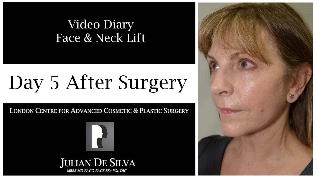 Facelift & Neck Lift Video Diary Day 5 After Surgery