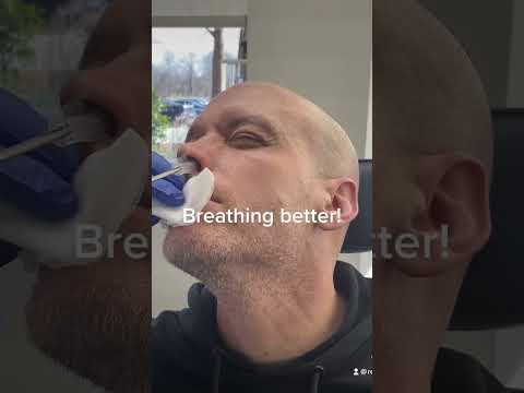 Another nasal splint removal after septoplasty and turbinate reduction